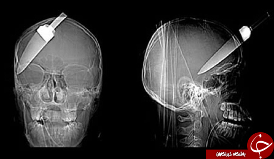 باورنکردنی‌ترین اشیا در بدن انسان+تصاویر