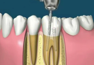 ویدئوی جالب از عصب کشى و روکش کردن دندان + فیلم