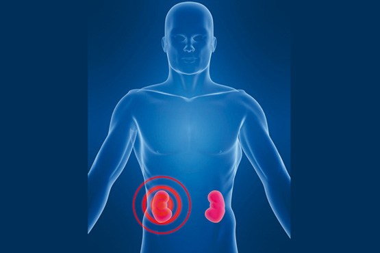 بیماری‎های کلیوی در کمین ۴۰ میلیون ایرانی