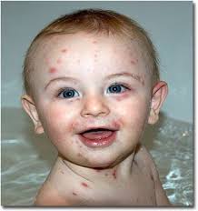 آبله‌مرغان سراغ چه کسانی می‌رود؟