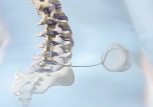 ایران پیشرو در درمان ضایعات نخاعی + فیلم