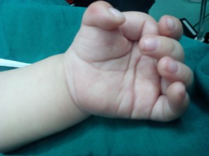 ازدواج فامیلی زمینه ساز مشکلات ارتوپدی در اطفال