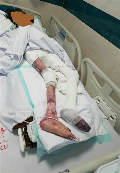 دختر مبتلا به بیماری «ای‌بی»، درگذشت