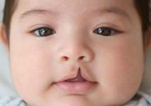 تلاش نصف جهان در برطرف کردن آلام کودکان خاص + فیلم