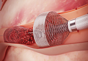 خارج کردن لخته خون از رگ به روشی نوین + فیلم