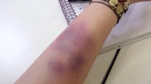 خونریزی و خون مردگی زیر پوستی +راه‌های درمان