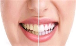 ماجرای نایاب شدن کارپول بی‌حسی دندان/ کاهش آمار مراجعین برای درمان