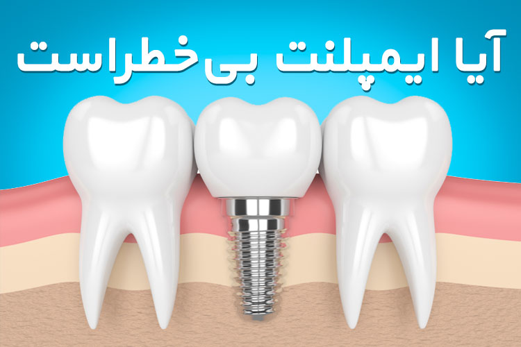 ایمپلنت یک روش برای جایگزین کردن دندان از دست رفته است